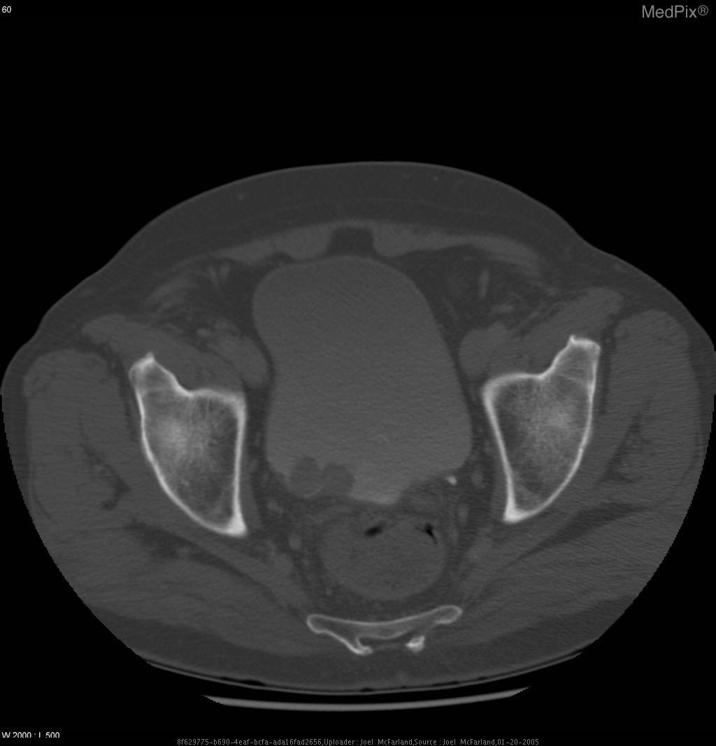 bladder-cancer-thedoctab