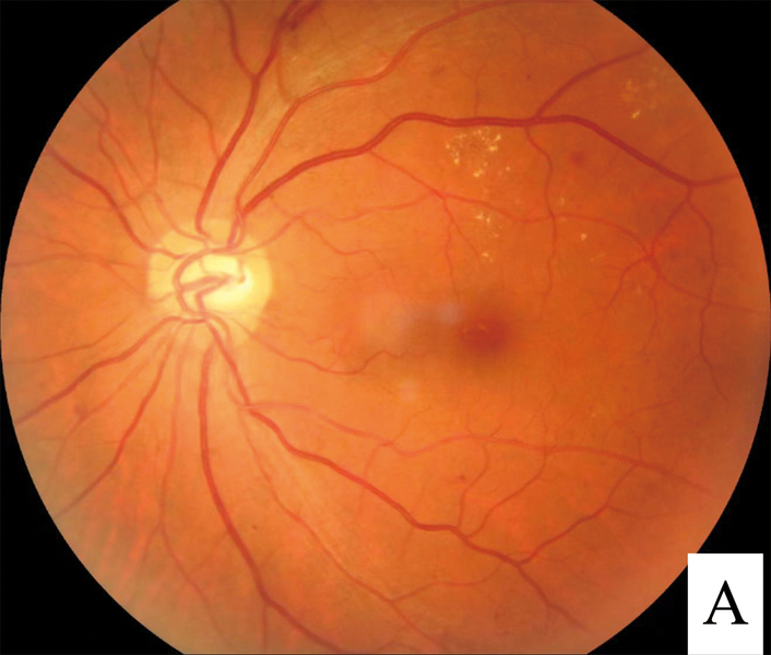 A fundus image showing several signs of diabetic retinopathy: hard exudates (scattered yellowish dots), microaneurysms (bulges off some blood vessels), and small hemorrhages (blurry red dots)